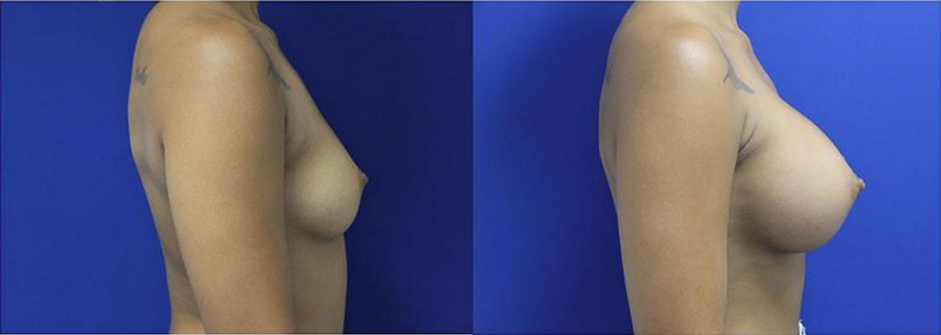 Breast Augmentation, Breast Implants