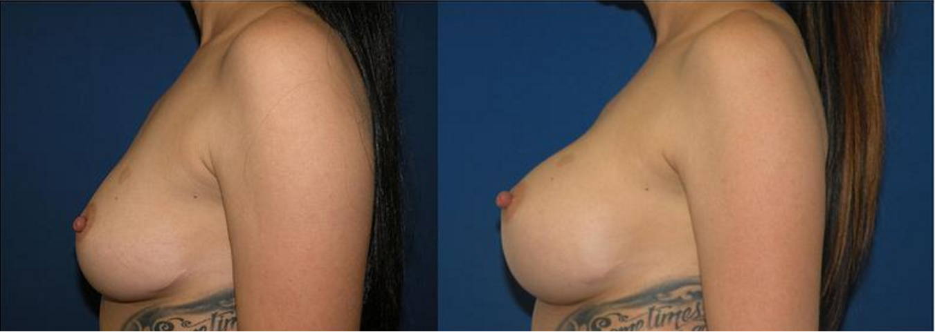 Breast Augmentation, Breast Implants