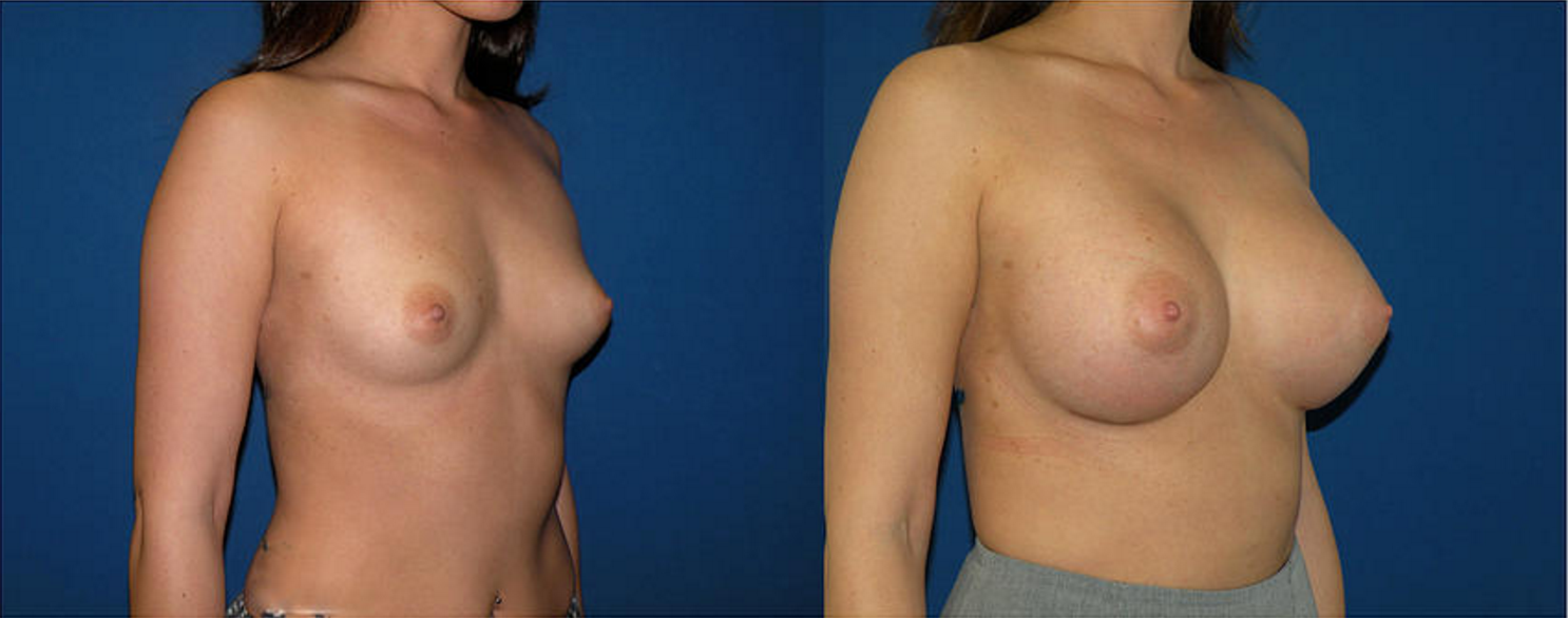 Breast Augmentation, Breast Implant