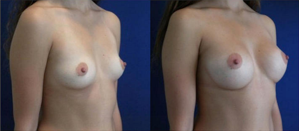 Breast Augmentation, Breast Implant