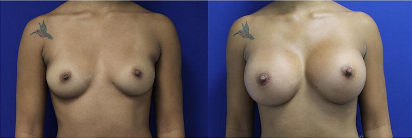 Breast Augmentation, Breast Implants