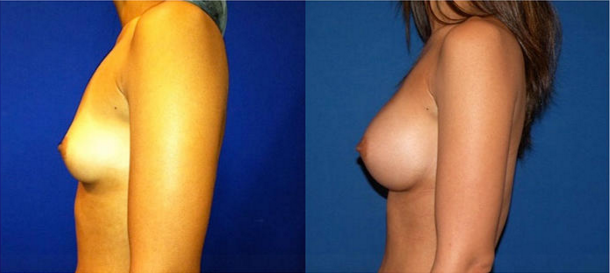 Breast Augmentation, Breast Implant