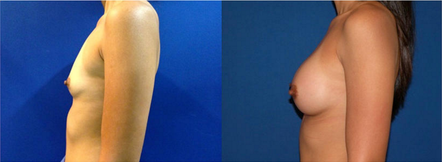Breast Augmentation, Breast Implant