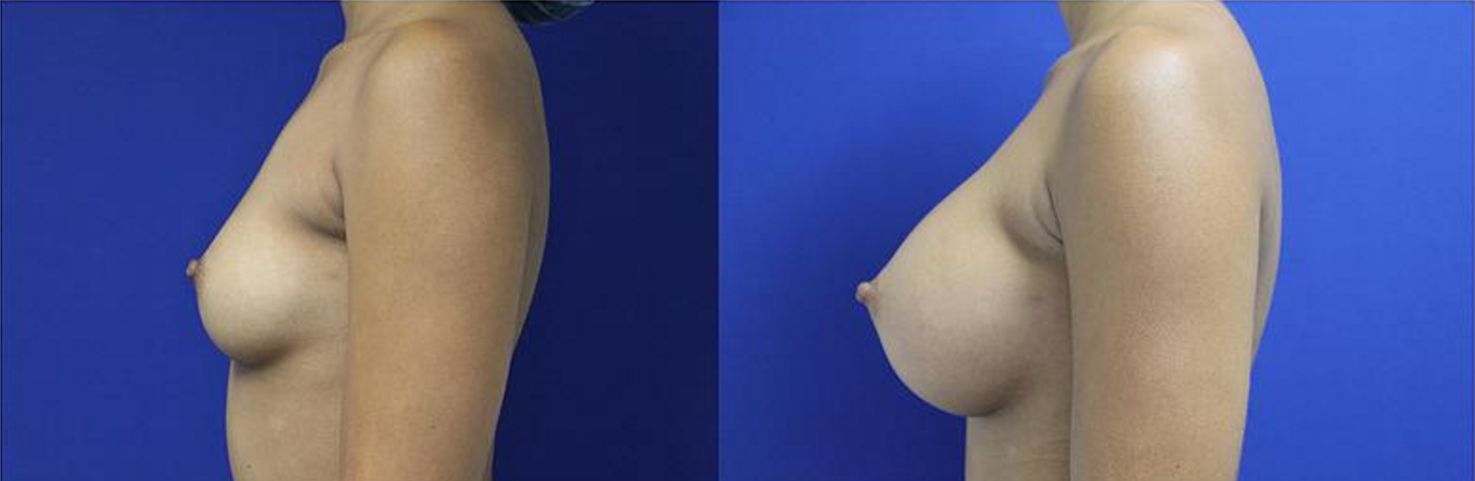 Breast Augmentation, Breast Implants