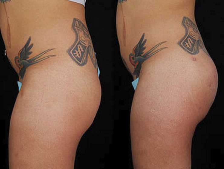 Buttock Augmentation - View 1