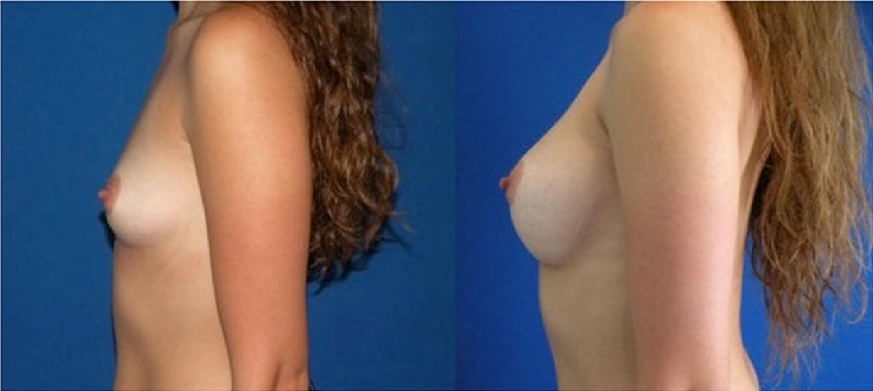 Breast Augmentation, Breast Implant