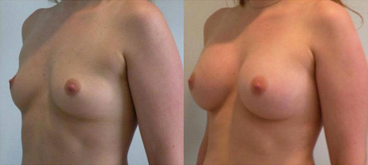 Breast Augmentation, Breast Implant