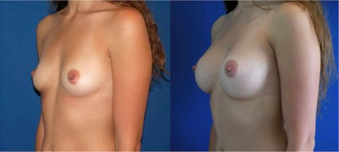 Breast Augmentation, Breast Implant