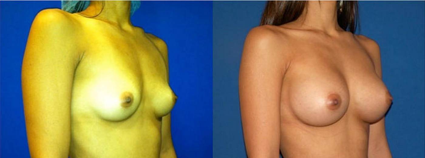 Breast Augmentation, Breast Implant