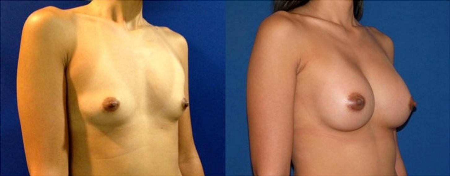 Breast Augmentation, Breast Implant