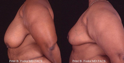 Breast Reduction & Lift- View 3