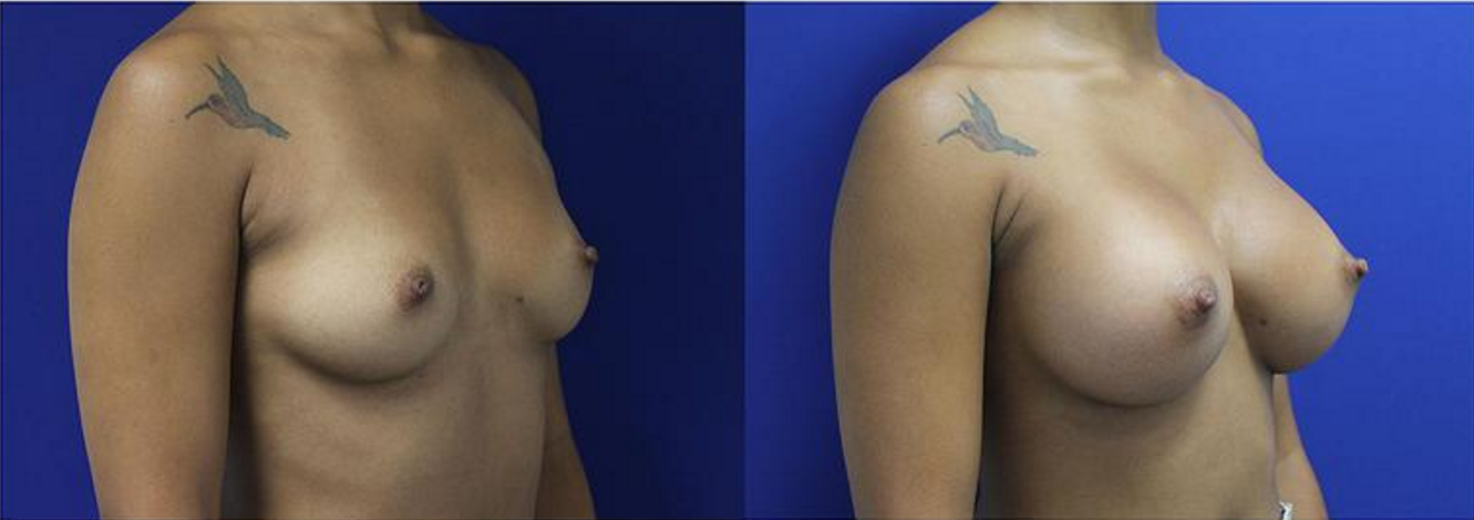 Breast Augmentation, Breast Implants