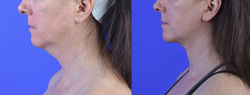 Neck Lift