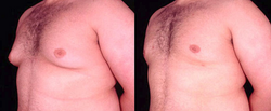 Gynecomastia - View 2