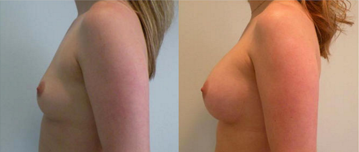 Breast Augmentation, Breast Implant