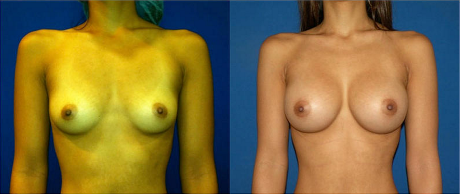 Breast Augmentation, Breast Implant