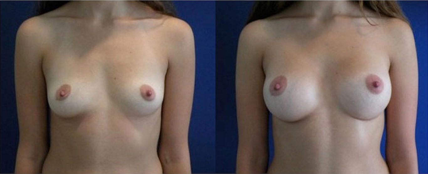 Breast Augmentation, Breast Implant