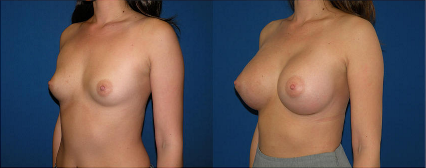 Breast Augmentation, Breast Implant
