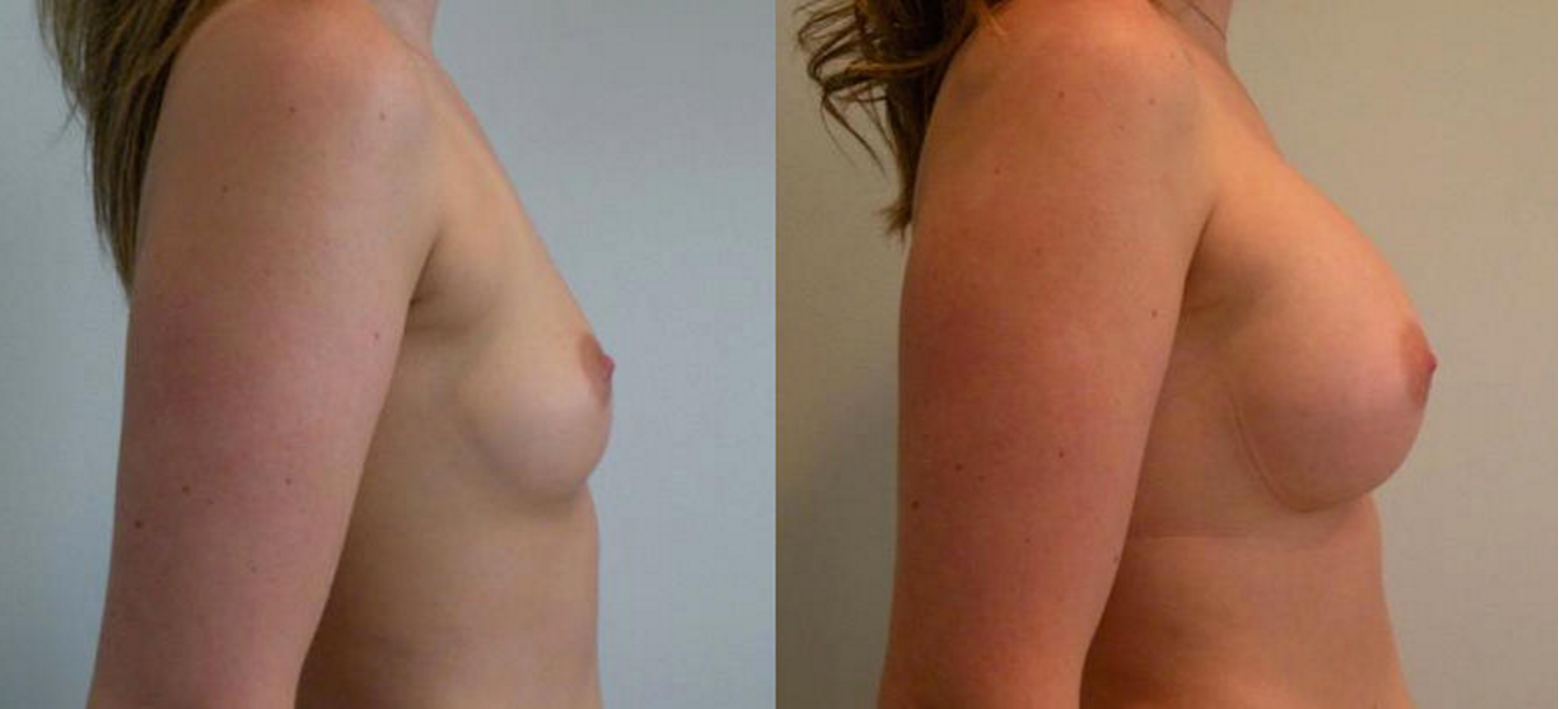 Breast Augmentation, Breast Implant