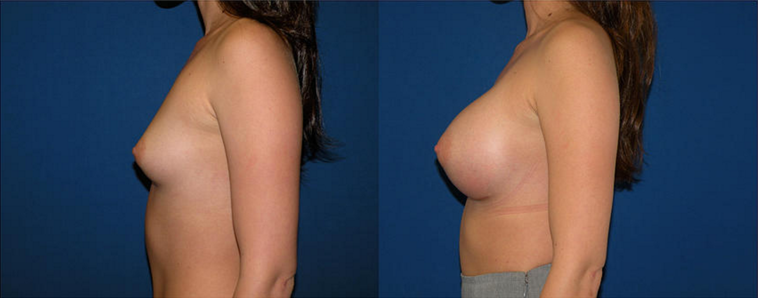 Breast Augmentation, Breast Implant