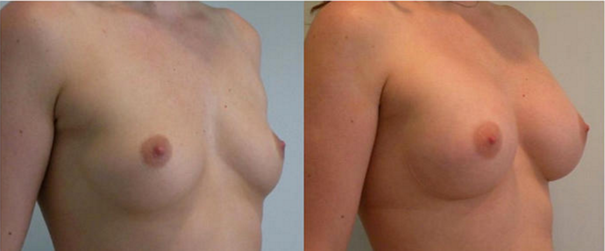 Breast Augmentation, Breast Implant