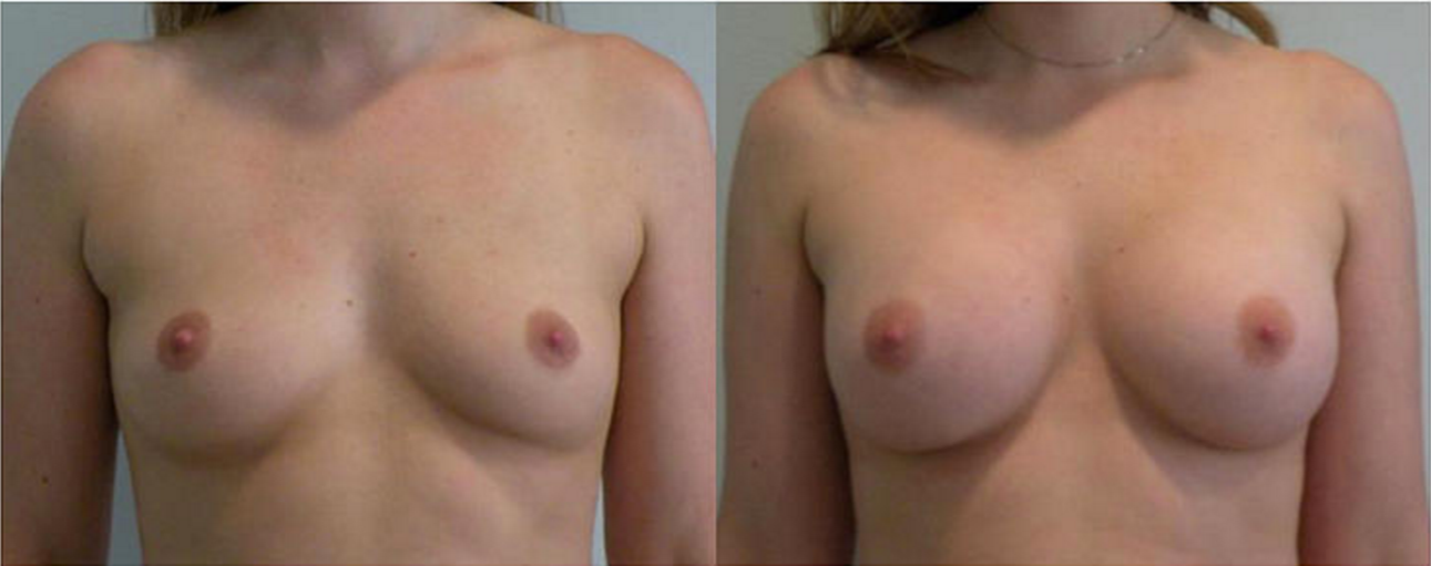 Breast Augmentation, Breast Implant