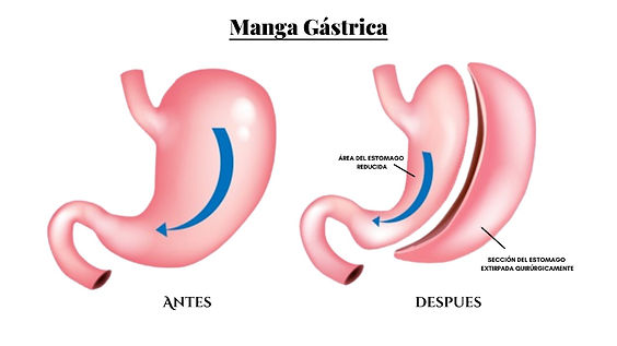 antes y después de una manga gastrica