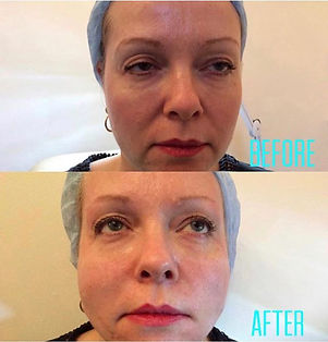 Exclusive at Harley Street Elite Clinic 