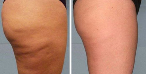 cellulite-before-after.jpg