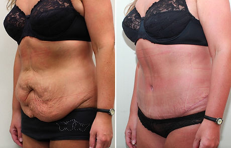 abdominoplasty-tummy-tuck-london_edited.