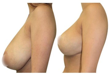 breast-reduction-london.jpg