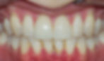 veneers after