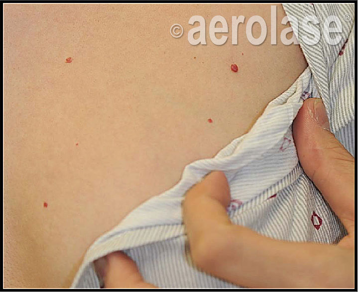 Angioma Before