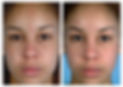 Diamond microdermabrasion before after.j