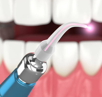 laser-dental-2.jpg