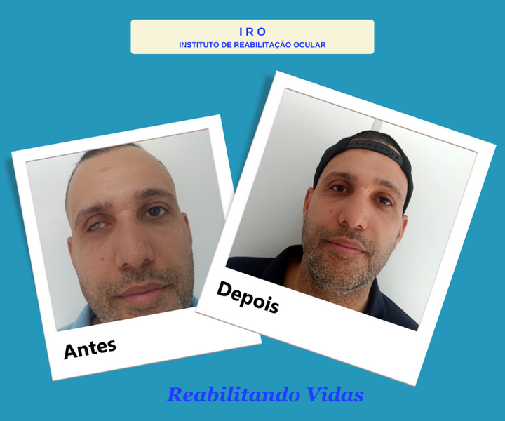 Antes e depois de reabilitação com prótese ocular na IRO