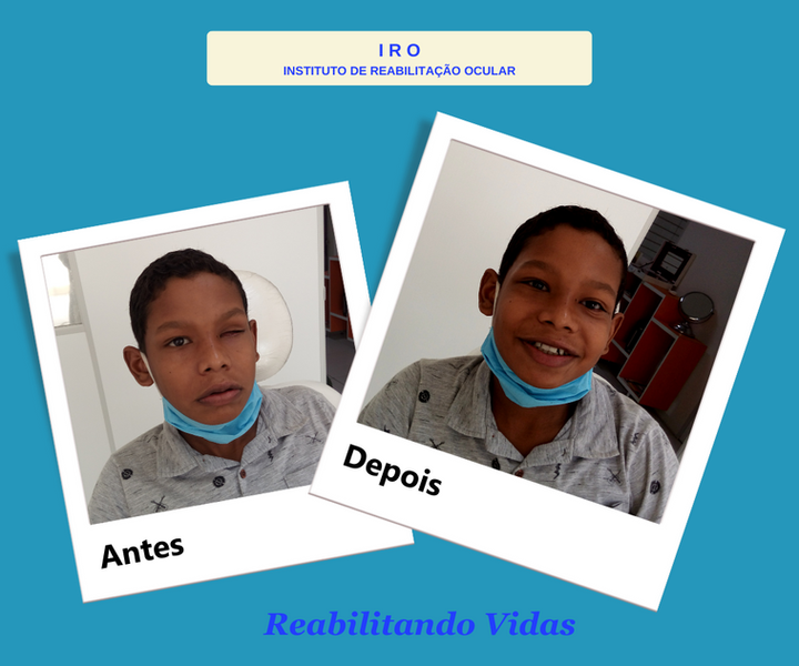 Antes e depois de reabilitação com prótese ocular na IRO