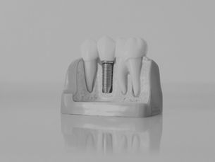 Two health teeth with a dental implant in-between