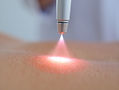 High Power laser Therapie