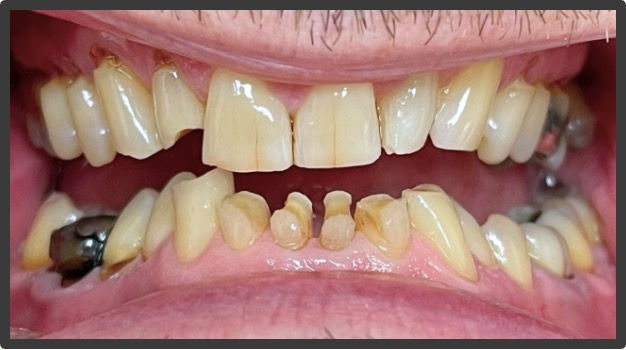 Composite Buildups
