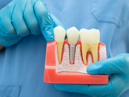 Understanding Root Canals: What to Expect Before, During, and After