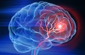 Stroke: The Brain’s Surprise Attack