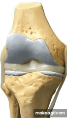 osteoarthritis stages