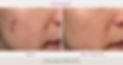 BA-Exceed-MTDerm-4Tx-003.jpg