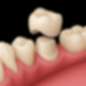 dental-crown-image