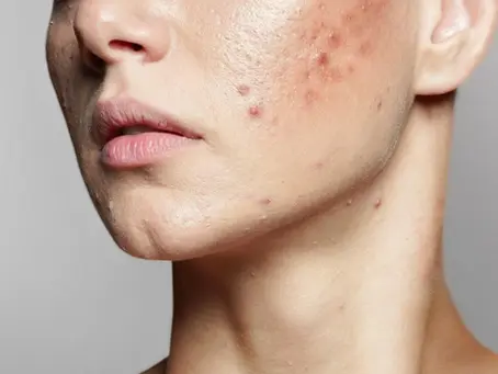 רואקוטן - הטיפול היעיל ביותר לטיפול באקנה