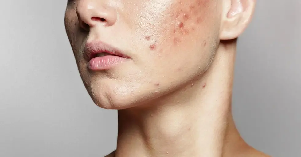 רואקוטן - הטיפול היעיל ביותר לטיפול באקנה