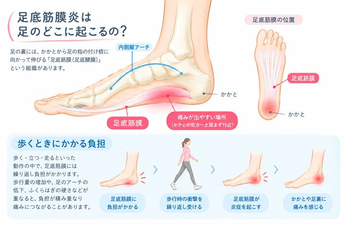 足底筋膜炎(足底健膜炎)の説明