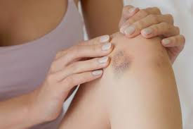 A Conexão Surpreendente Entre Ansiedade e Manchas Roxas: Entendendo os Impactos Físicos