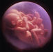 Multiple Pregnancies
